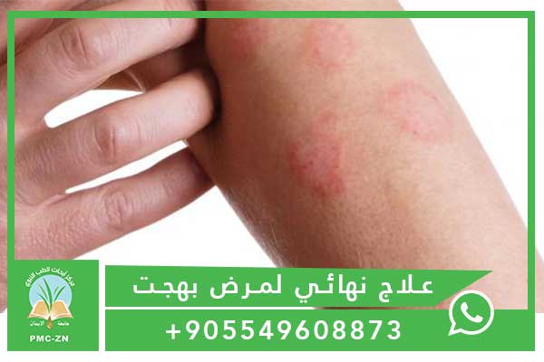 علاج نهائي لمرض بهجت مرض بهجت والزواج و علاج مرض بهجت