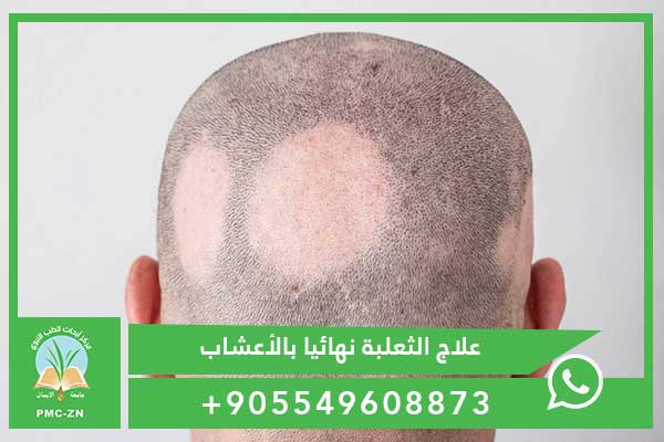 علاج الثعلبة نهائيا بالأعشاب