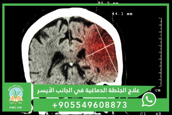 علاج الجلطة الدماغية في الجانب الأيسر