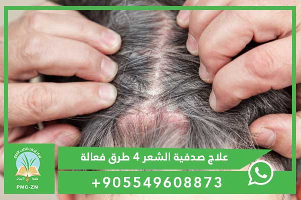 علاج صدفية الشعر في المنزل